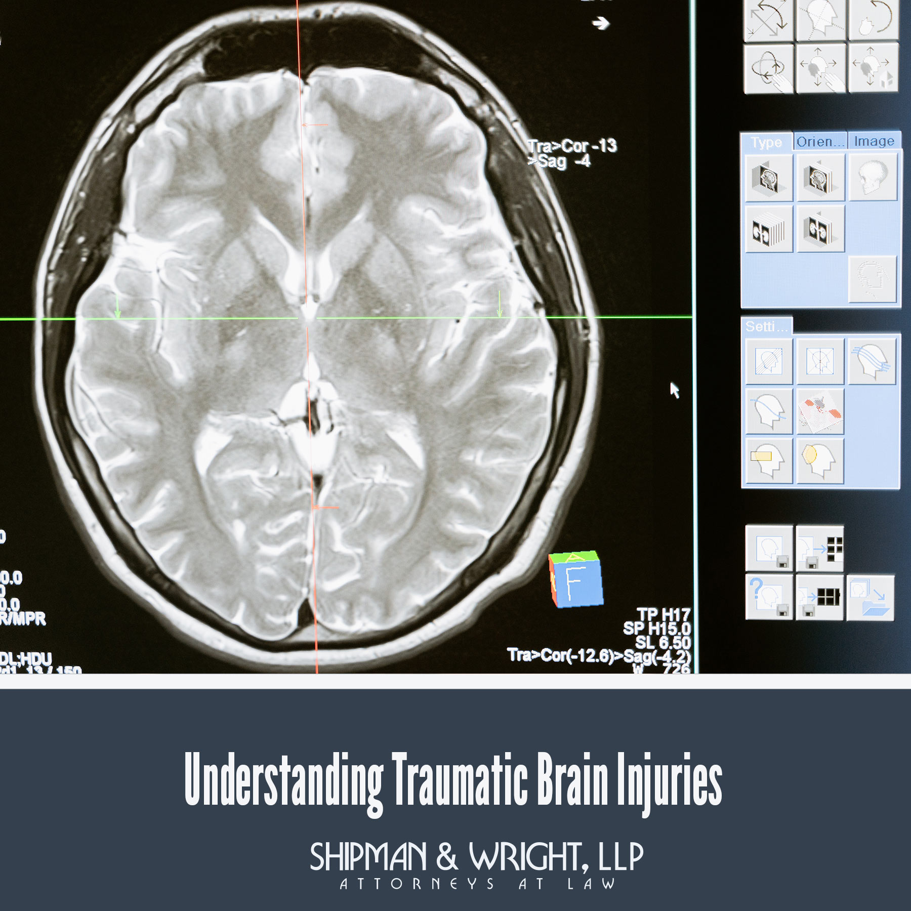 Understanding Traumatic Brain Injuries